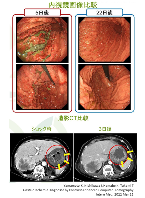 PubMed論文掲載報告~Intern Med誌:筆頭著者 山本一太先生~