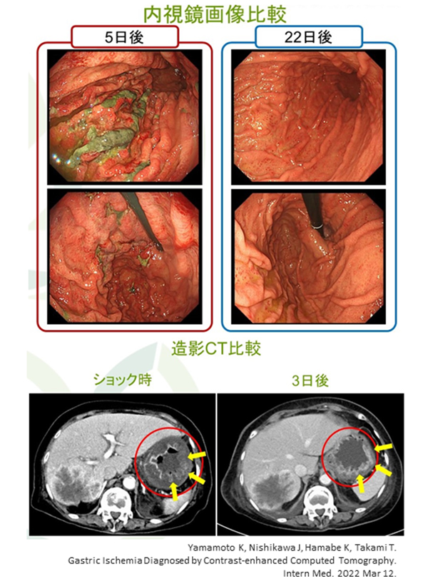 PubMed論文掲載報告～Intern Med誌：筆頭著者 山本一太先生～