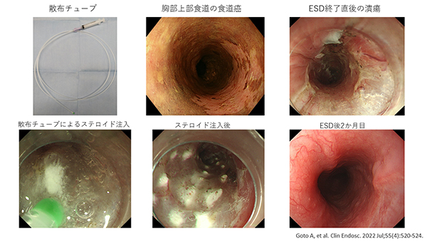 PubMed論掲載報告 ～Clinical Endoscopy誌：筆頭著者 五嶋敦史 助教～