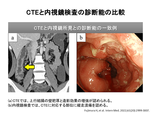 PubMed論文掲載報告 ～Intern Med誌：筆頭著者 藤村寛之先生～