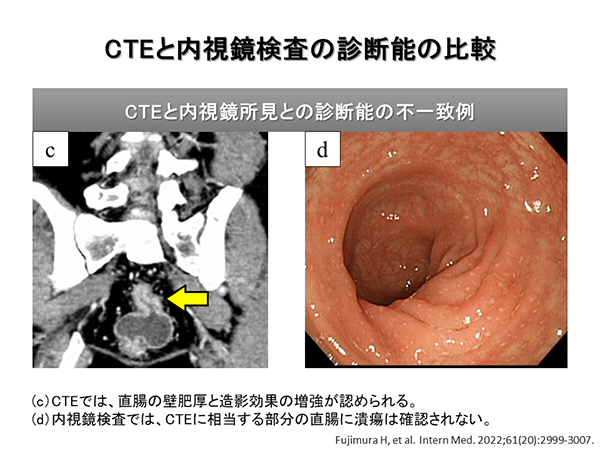 PubMed論文掲載報告 ～Intern Med誌：筆頭著者 藤村寛之先生～