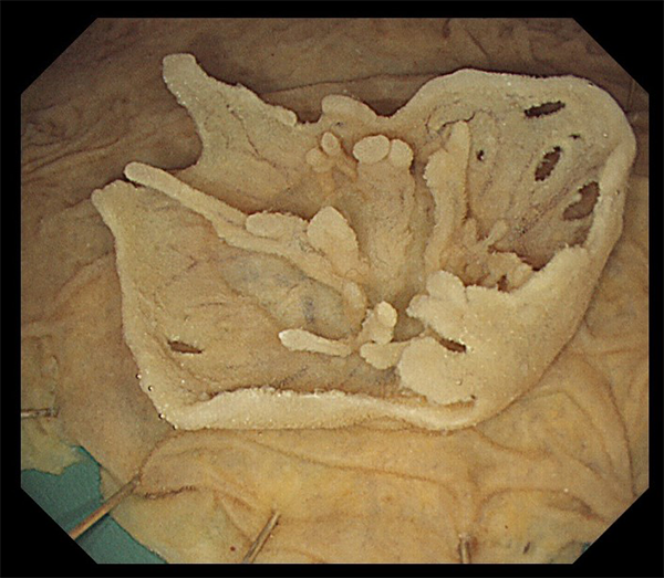 PubMed論文掲載報告 ~Gastrointestinal Endoscopy誌(IF10.396):筆頭著者 浜辺功一 助教~