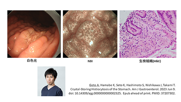 PubMed論文掲載報告 ～Am J Gastroenterol. (IF12.045)：筆頭著者 五嶋敦史～